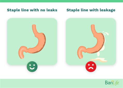 signs of gastric sleeve leak|Gastric Sleeve Leak: Signs & Symptoms of Staple Line Leak